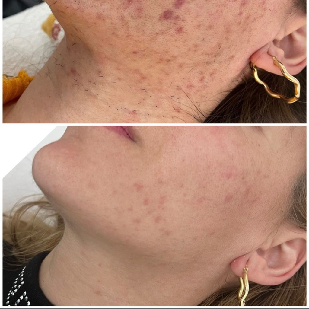 Dauerhafte Haarentfernung Dortmund – Laserbehandlung bei Noble Skin